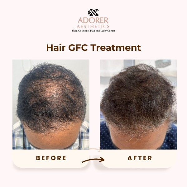 Before After Skin Treatment