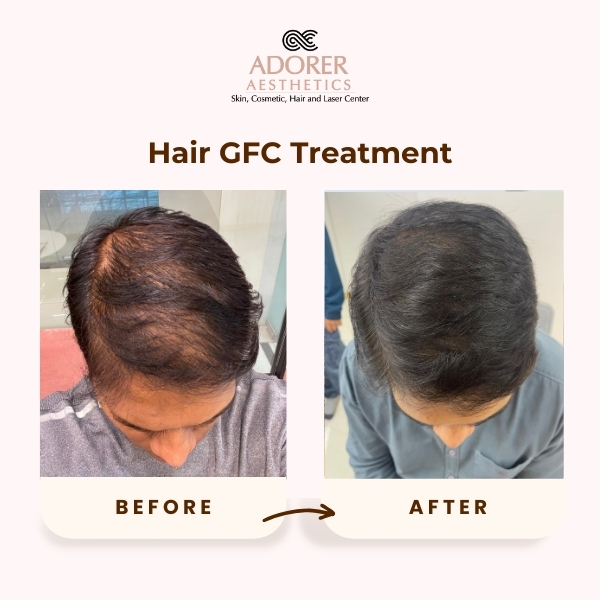 Before After Skin Treatment