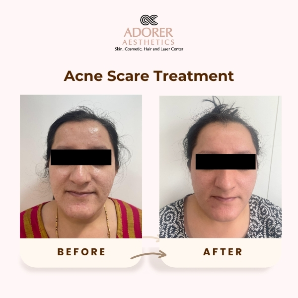 Before After Skin Treatment