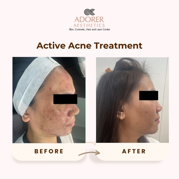 Before After Skin Treatment