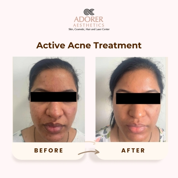 Before After Skin Treatment