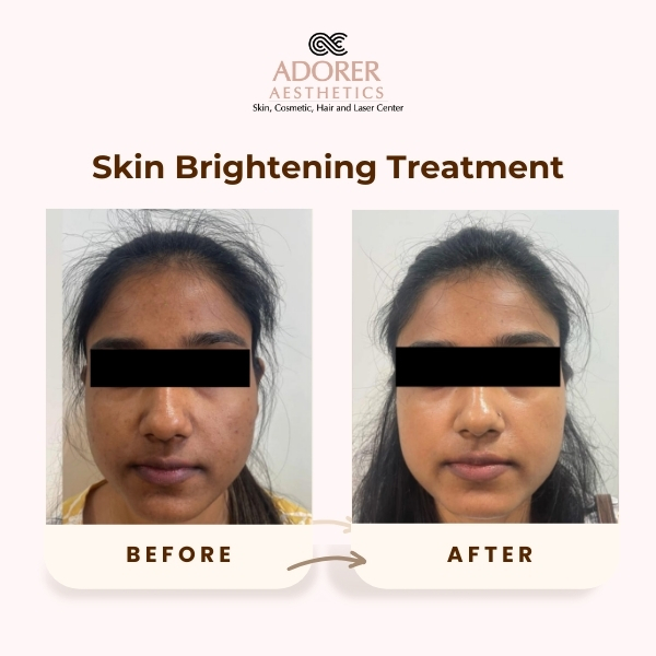 Before After Skin Treatment