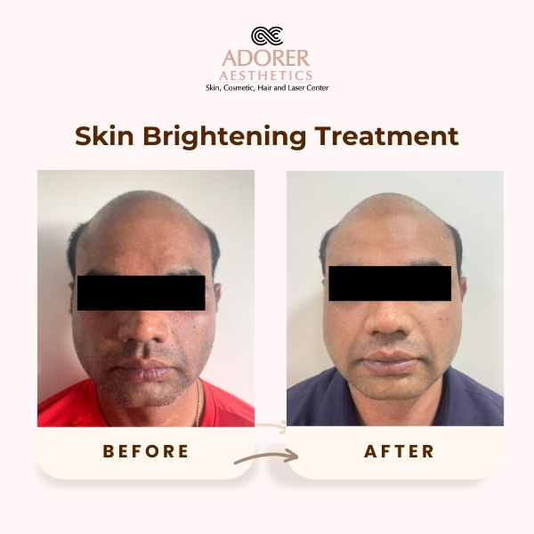Before After Skin Treatment