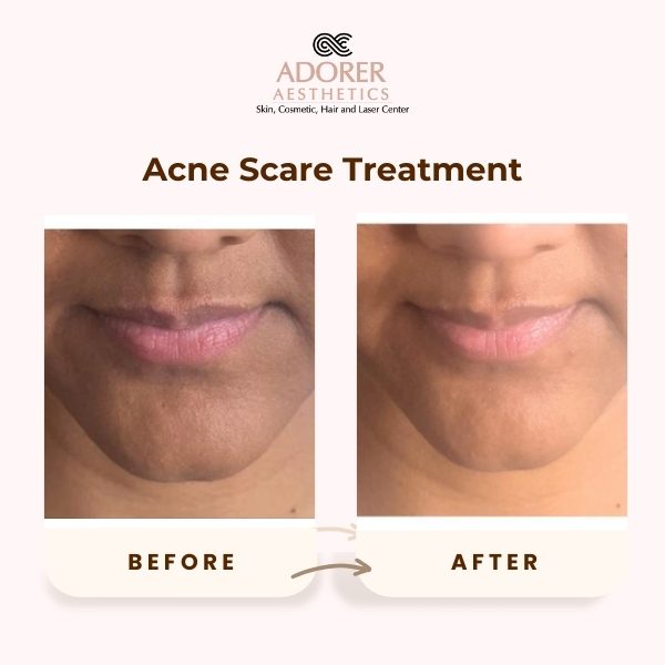 Before After Skin Treatment